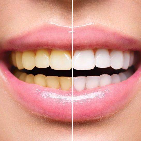 estética dental