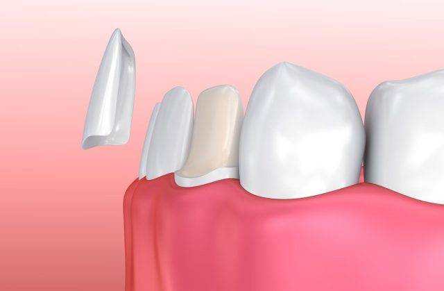 carillas dentales