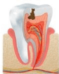 Proceso de caries