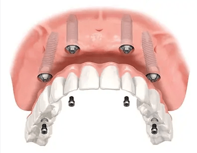 prótesis dental
